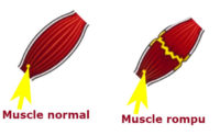rupture musculaire